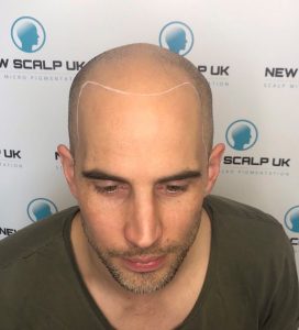 SMP for Alopecia consultation