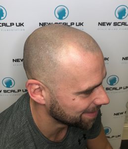 new male hair loss treatment