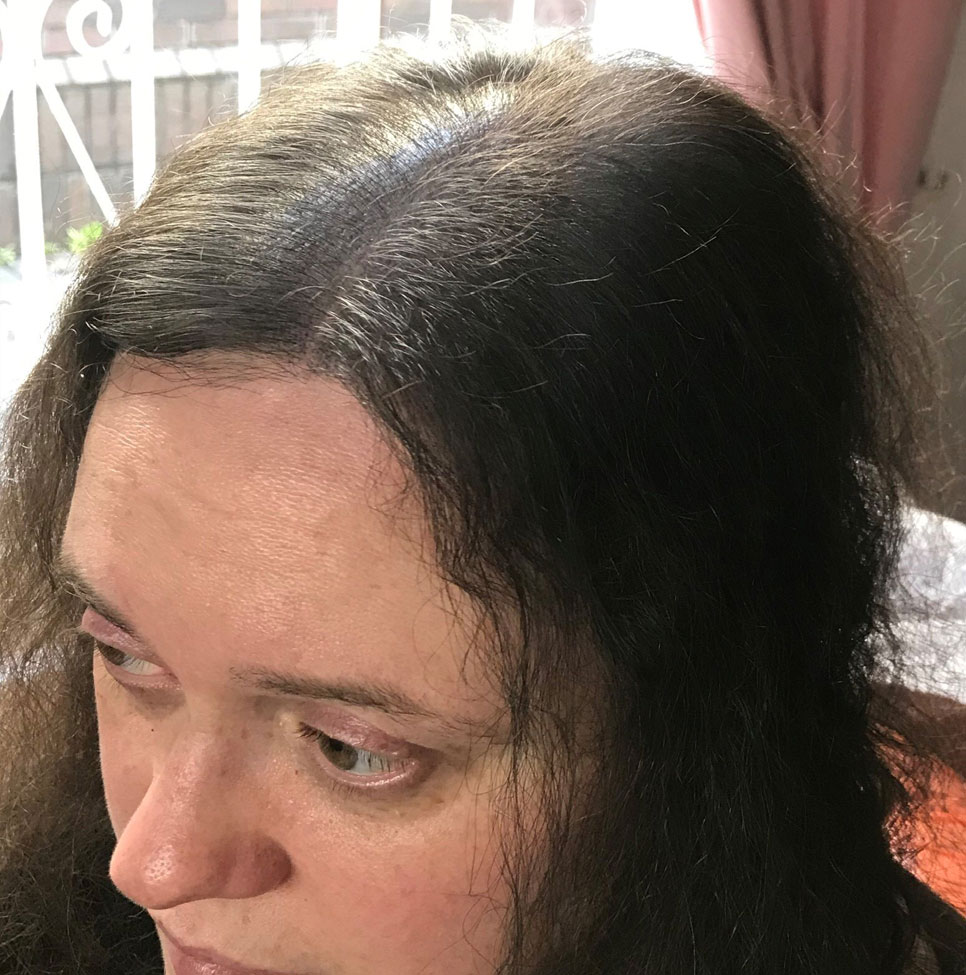 Hair Loss treatments